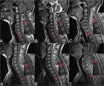 A Case With IgG4-Related Spinal Pachymeningitis Causing Spinal Cord Compression